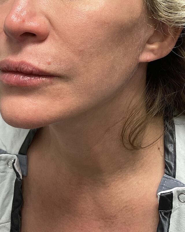 Neck Lift Before & After Image