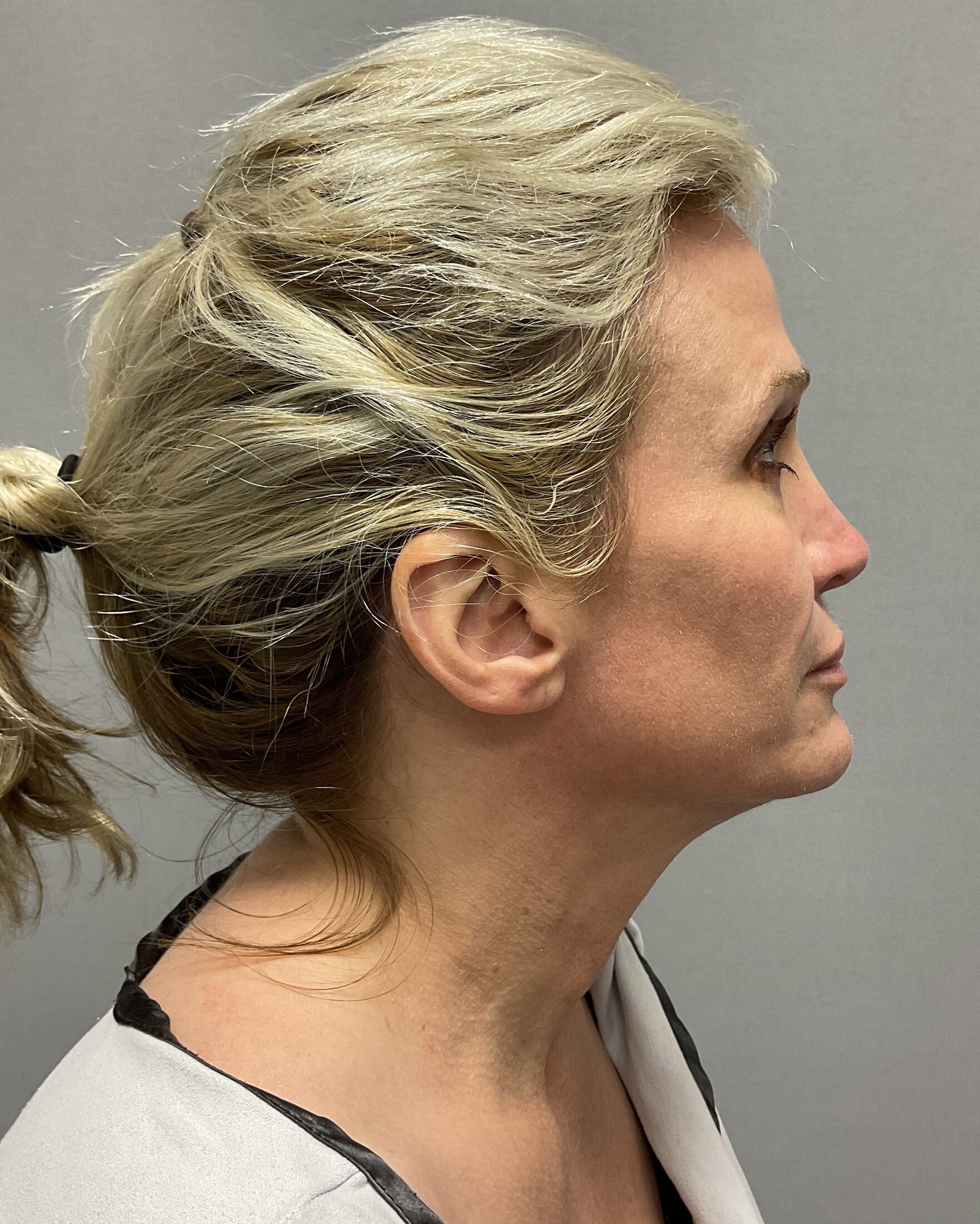 Neck Lift Before & After Image