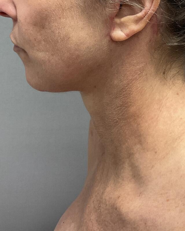 Neck Lift Before & After Image