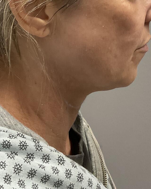 Neck Lift Before & After Image