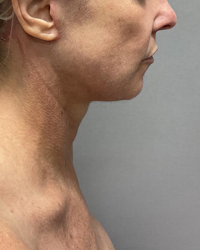 Neck Lift Before & After Image