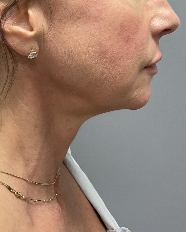 Neck Lift Before & After Image