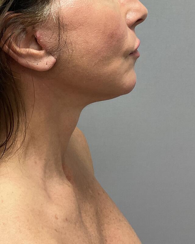 Neck Lift Before & After Image