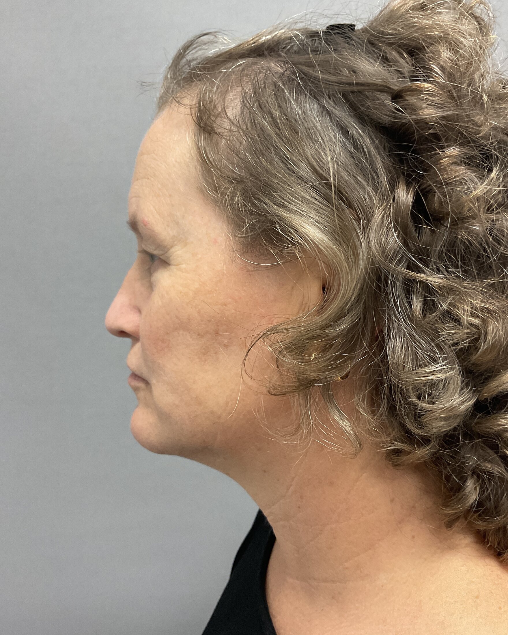 Neck Lift Before & After Image