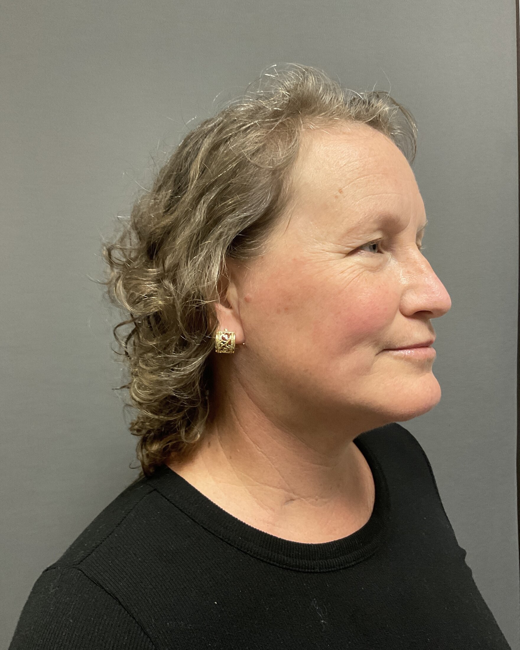 Neck Lift Before & After Image