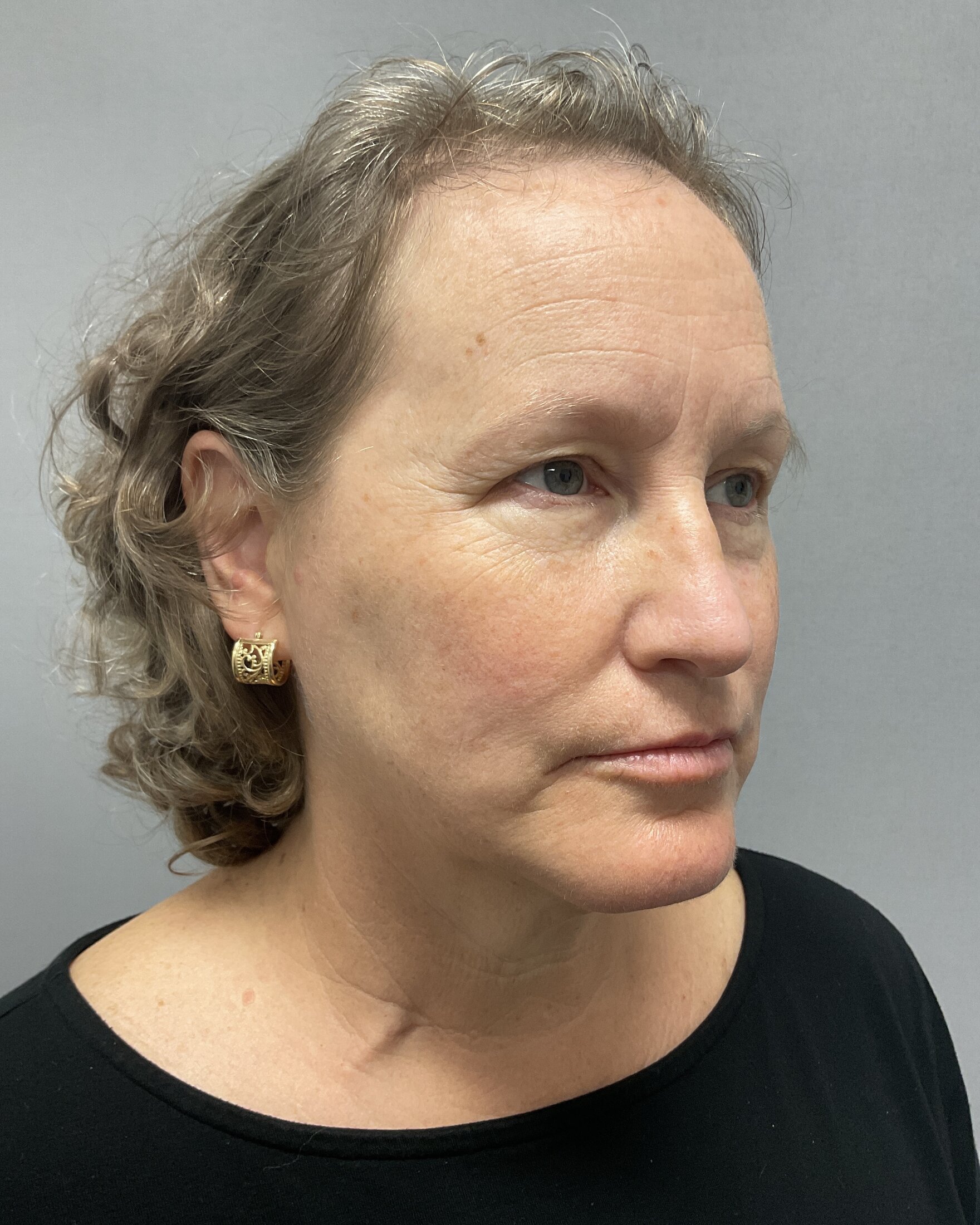 Neck Lift Before & After Image