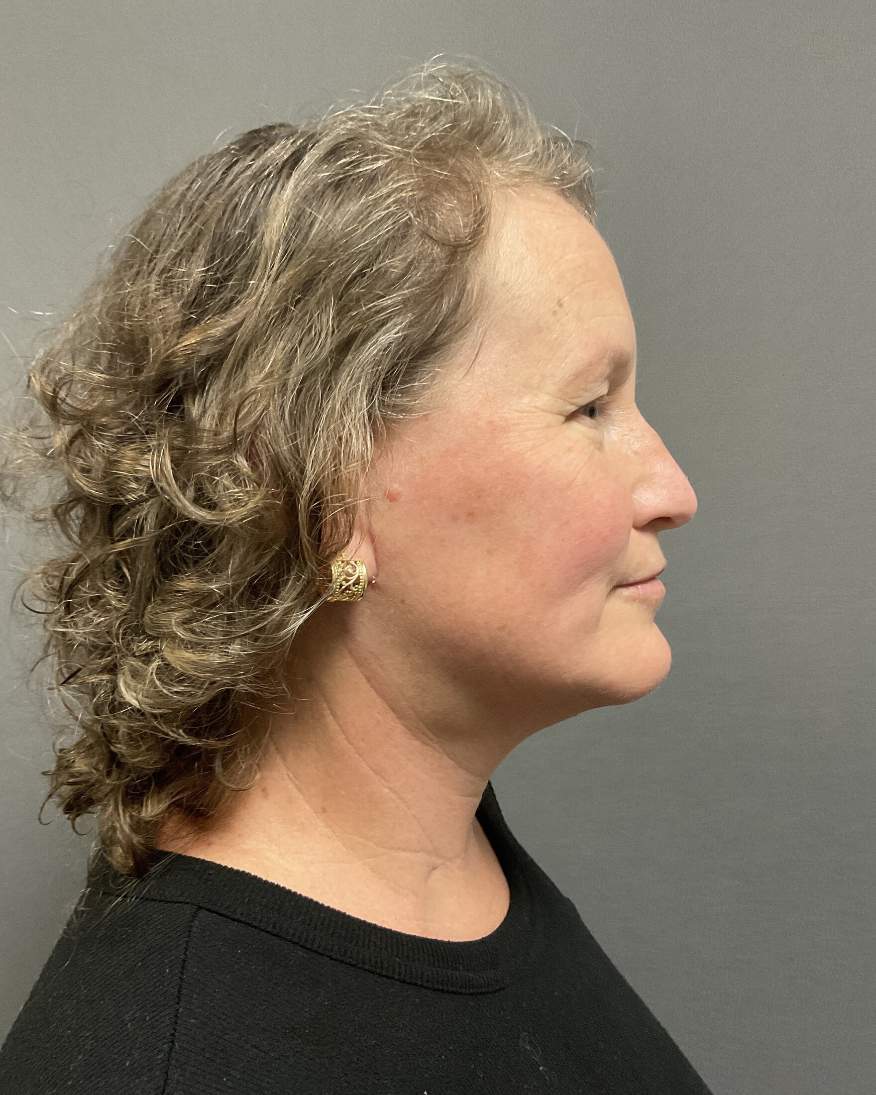 Neck Lift Before & After Image