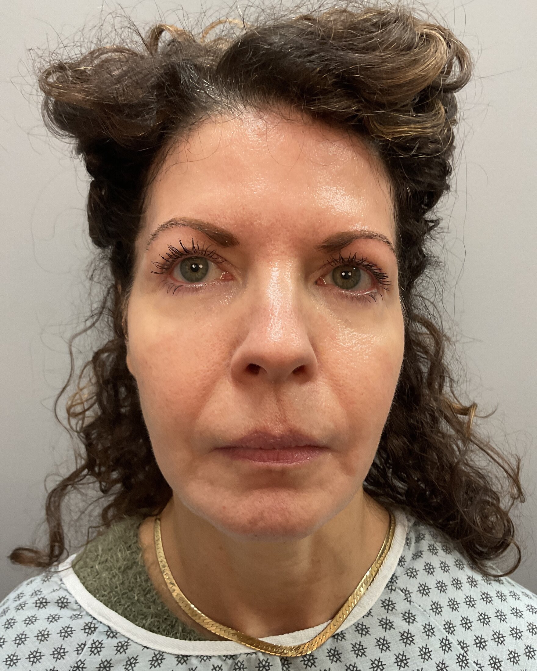 Neck Lift Before & After Image