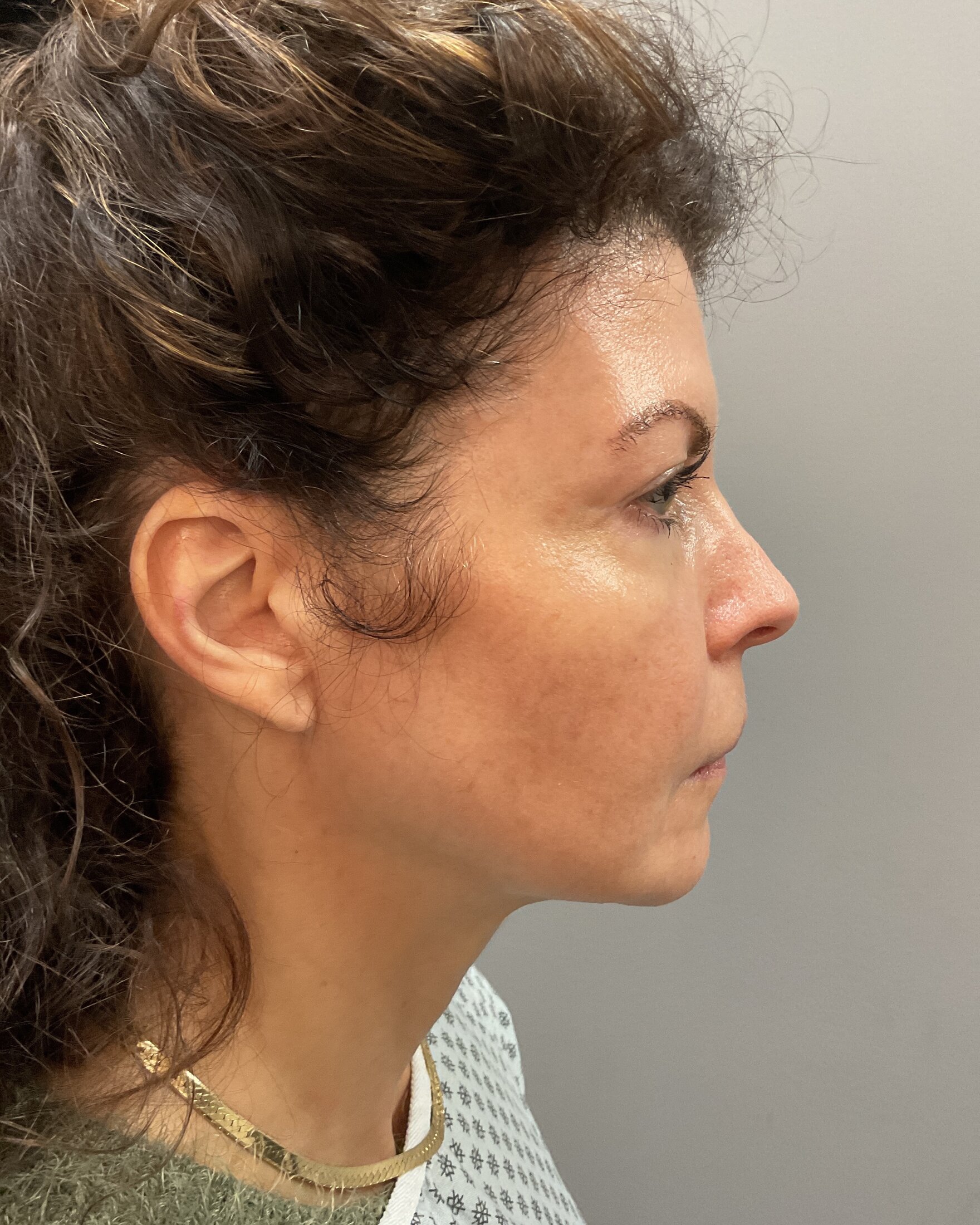 Neck Lift Before & After Image