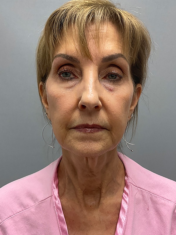 Neck Lift Before & After Image