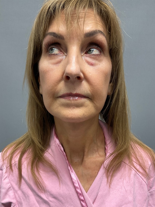 Neck Lift Before & After Image