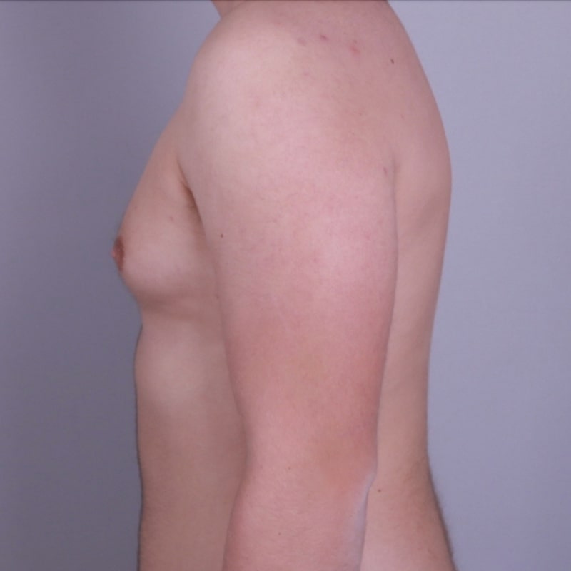 Gynecomastia Surgery Before & After Image