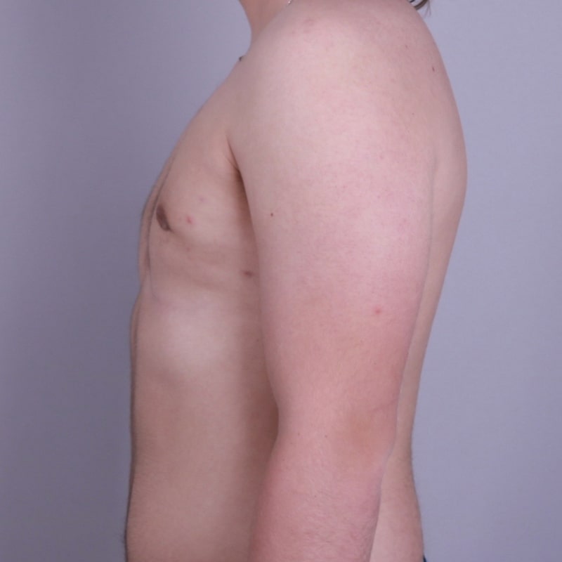 Gynecomastia Surgery Before & After Image