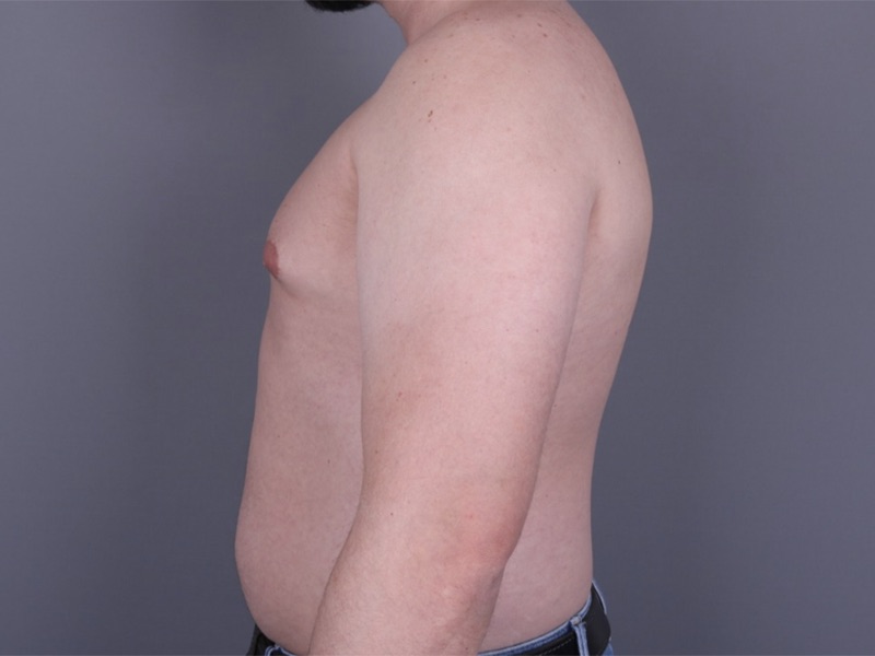 Gynecomastia Surgery Before & After Image