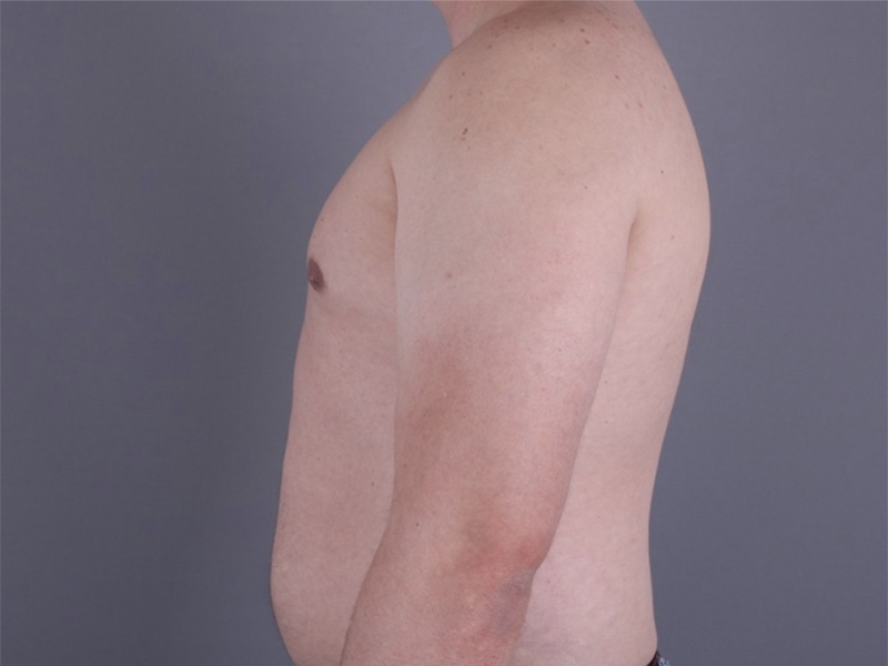 Gynecomastia Surgery Before & After Image