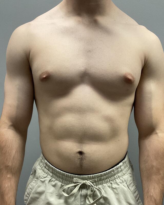 Gynecomastia Surgery Before & After Image