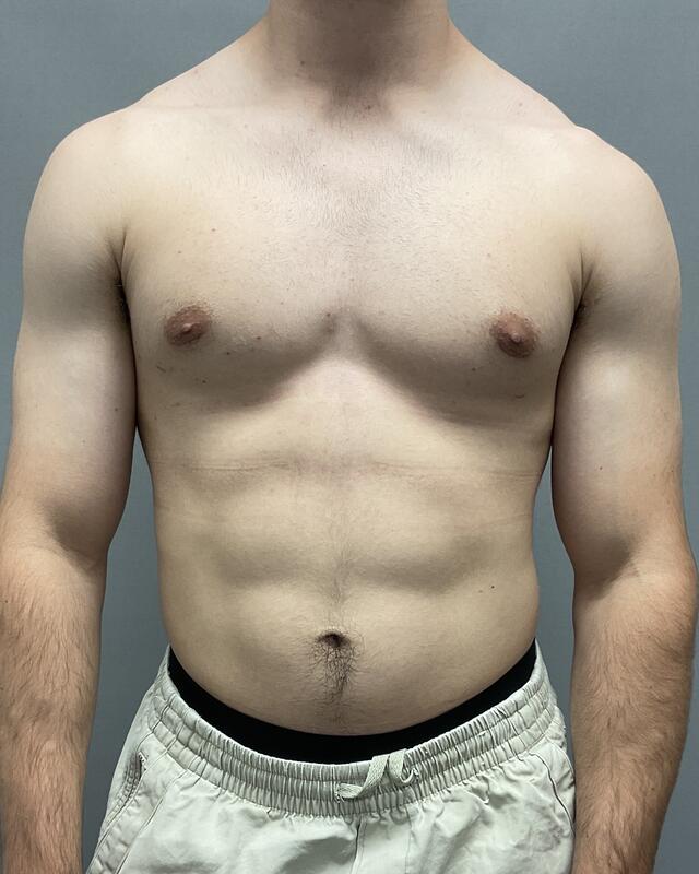 Gynecomastia Surgery Before & After Image