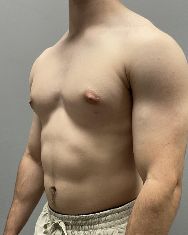 Gynecomastia Surgery Before & After Image