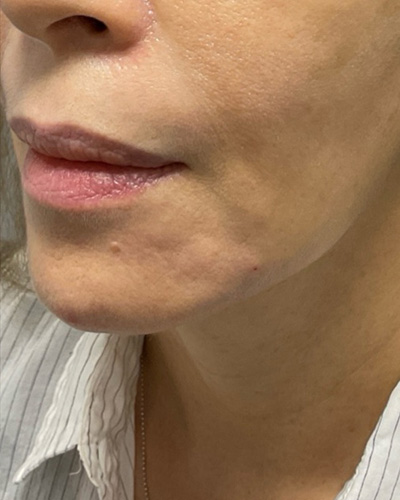 Dermal Fillers Before & After Image