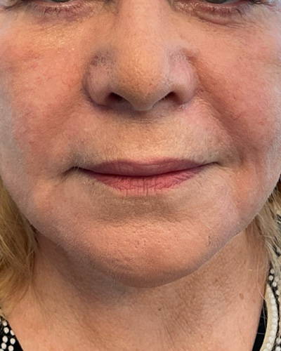 Dermal Fillers Before & After Image