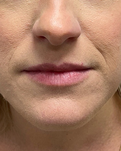 Dermal Fillers Before & After Image