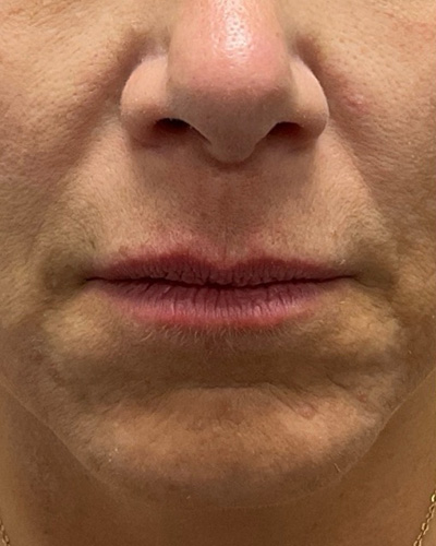 Dermal Fillers Before & After Image