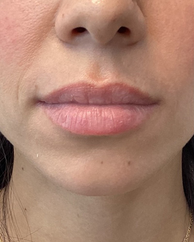 Dermal Fillers Before & After Image